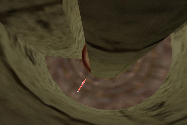 kz-endo_slide_svn_spiral